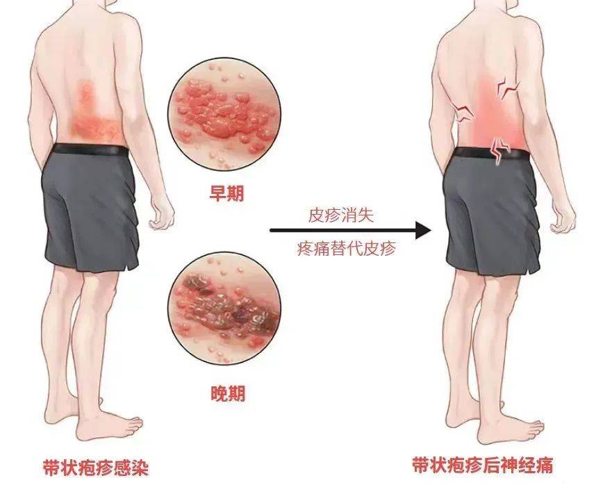 一旦感染终身携带<strong></p>
<p>网络虚拟币的分析</strong>！深圳疾控提醒：这4类人要注意