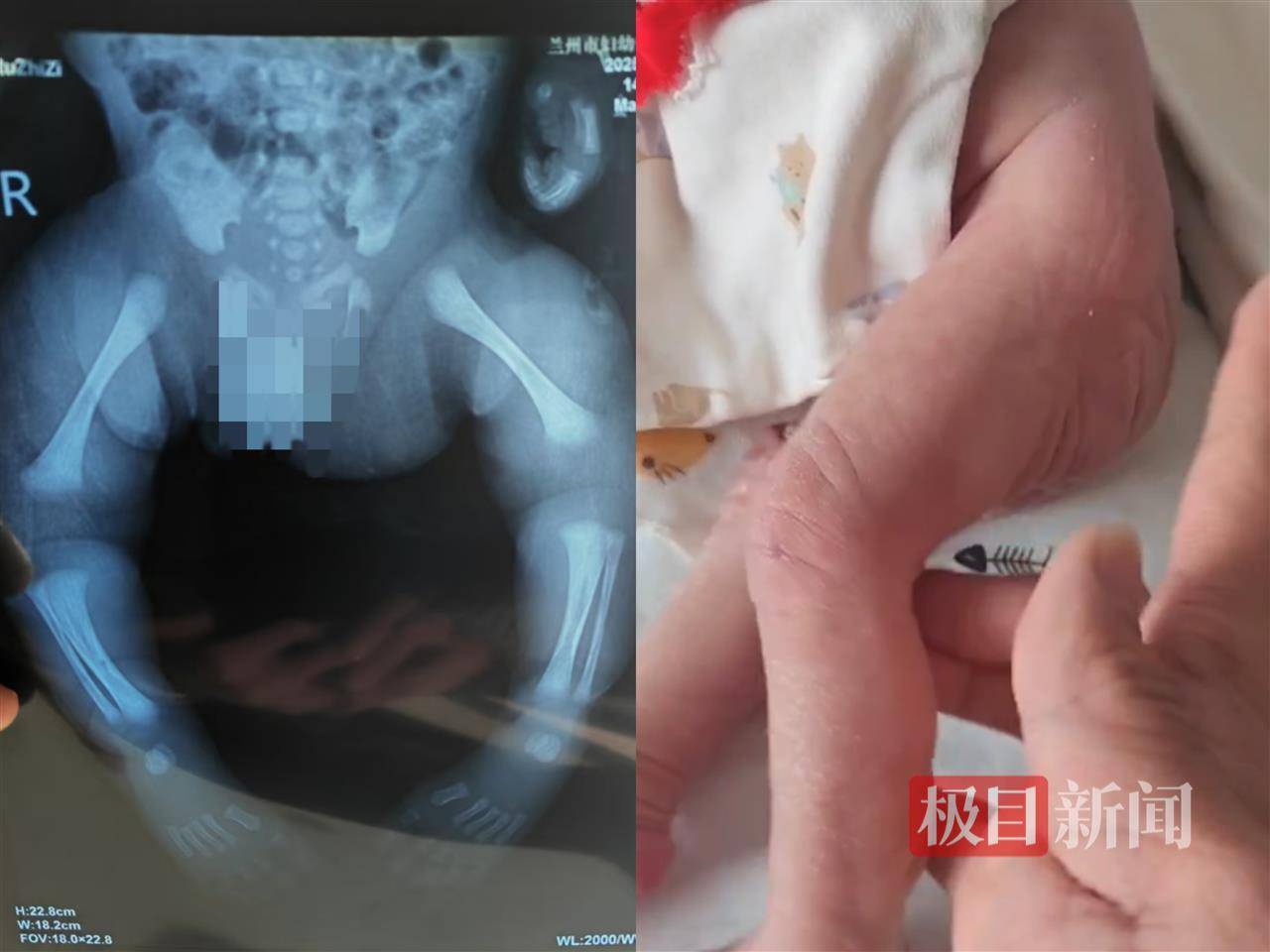 二胎出生查出先天性病症或落下残疾<strong></p>
<p>虚拟货币</strong>，残疾父母称医院产检漏检、未尽告知义务，医院及医调委回应