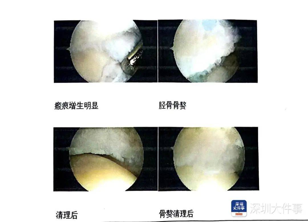 “一走路就痛”！女子脚踝受伤遭漏诊<strong></p>
<p>hbar币</strong>，治了7年没好！深圳一医院被告上法庭