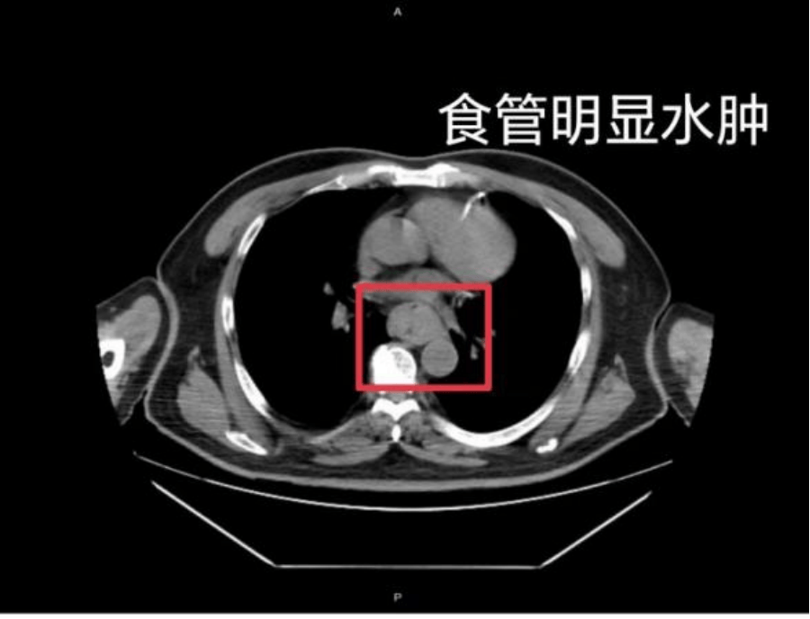 【家常话健康】一口热汤<strong></p>
<p>雷柏科技股票</strong>，差点要了幼童的命！不是所有东西都适合“趁热吃”