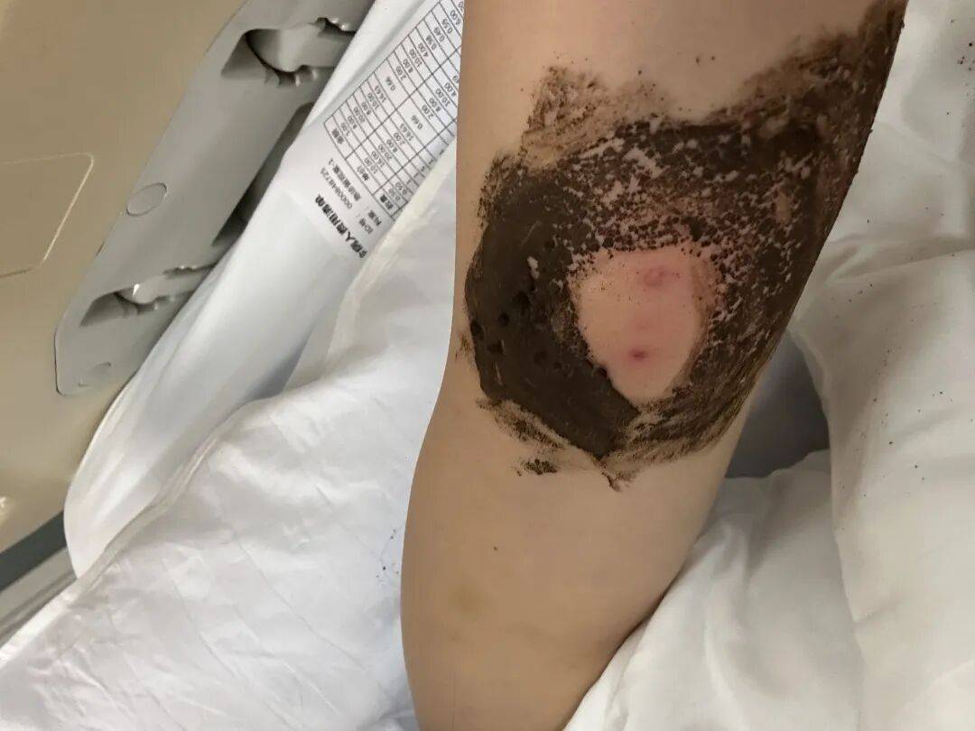 4名游客景区内遭马蜂袭击<strong></p>
<p>海南发展股票</strong>，旅游度假区：是森林公园不卖门票，蜇伤先就医后提供证据投诉