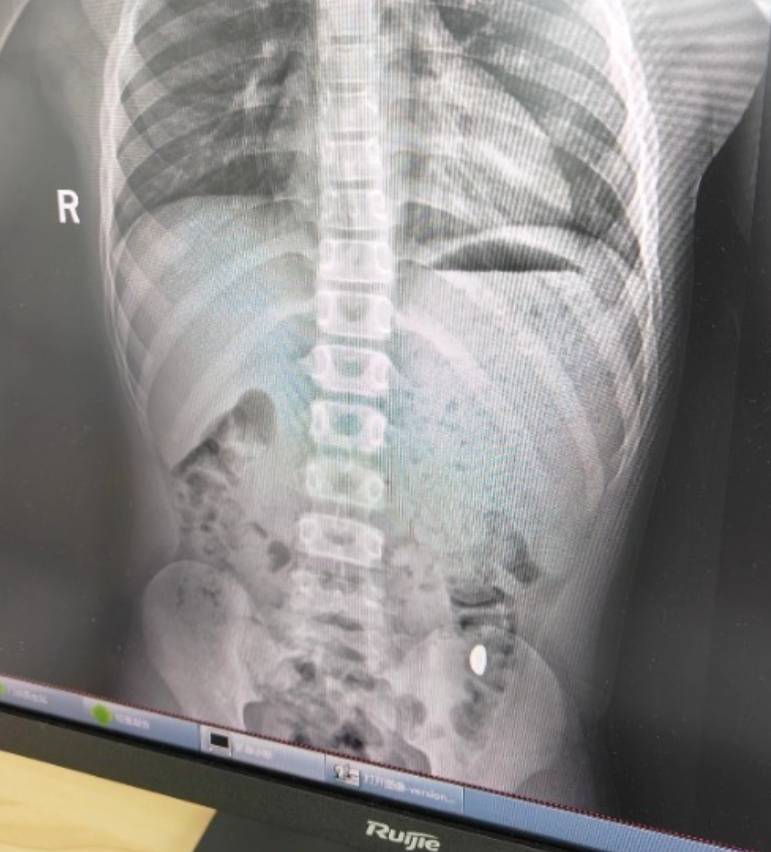 “熊孩子”误吞10克重金豆<strong></p>
<p>宝信软件股票</strong>,妈妈:天天叮嘱他不要在外面拉屎