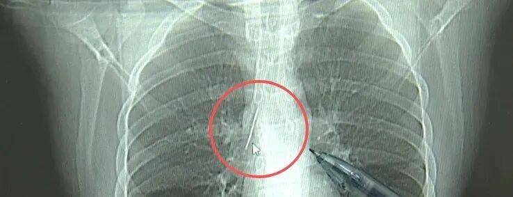 17岁小伙参军体检发现胸腔内有根5cm缝衣针，父母回忆或是1岁时扎入，取出时已锈迹斑斑