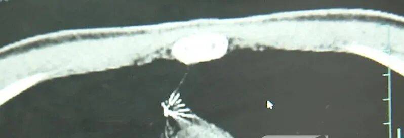 17岁小伙参军体检发现胸腔内有根5cm缝衣针<strong></p>
<p>双环传动股票</strong>，父母回忆或是1岁时扎入，取出时已锈迹斑斑