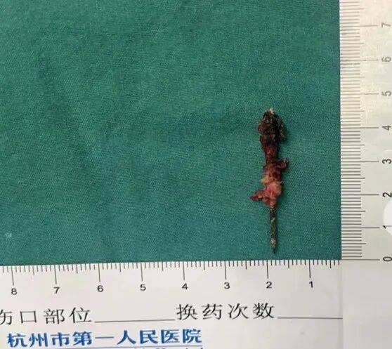 17岁小伙参军体检发现胸腔内有根5cm缝衣针<strong></p>
<p>双环传动股票</strong>，父母回忆或是1岁时扎入，取出时已锈迹斑斑